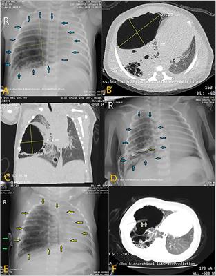 Percutaneous transthoracic catheter drainage prior to surgery in treating neonates with congenital macrocystic lung malformation presenting with respiratory distress